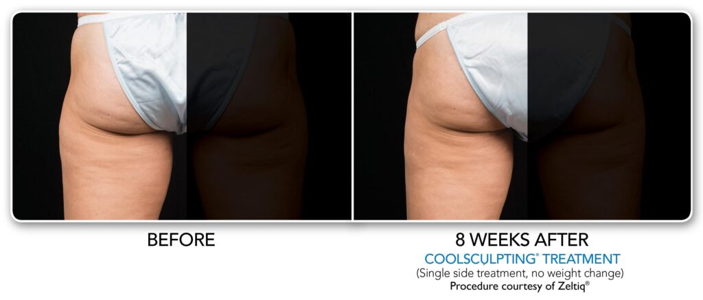 before and after zeltiq coolsculpting
