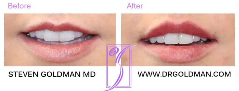 lip filler