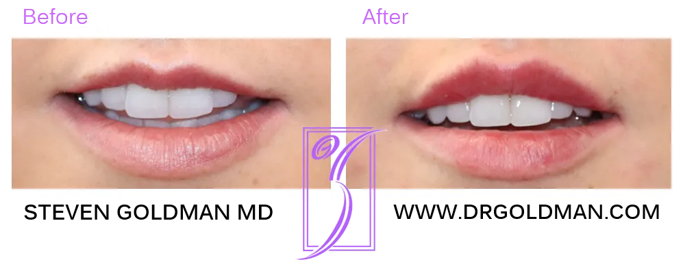 lip filler before and after