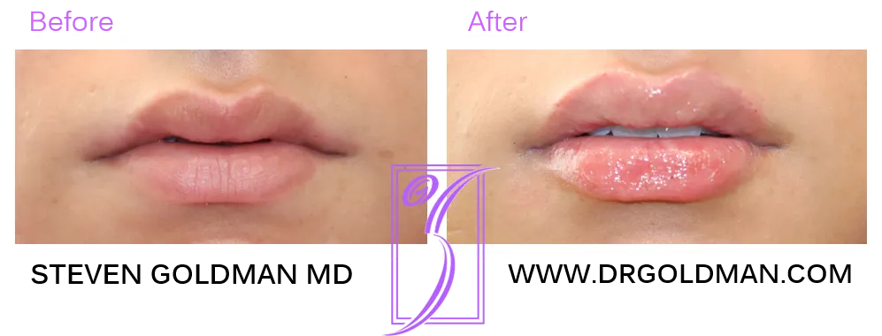 lip flip before/after